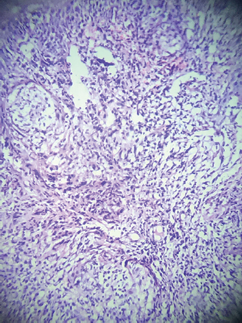 Histopathology showed epithelioid cells and few giant cells with granuloma and dense lymphatic infiltrate with foci of necrosis (H and E stain, ×40).
